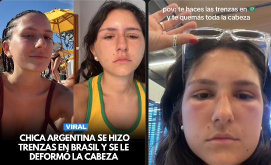 quemadura por trenzas